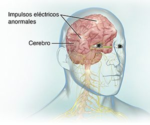 Vista frontal del cerebro y de la médula espinal con actividad cerebral epiléptica.
